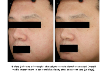Before and after 28 days acne treatment showing improved skin clarity in clinical photos