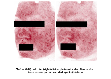 Before and after 28 days clinical photos showing reduced facial redness and dark spots-2
