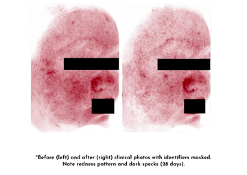 Before and after photos showing reduced skin redness and dark spots after 28 days treatment