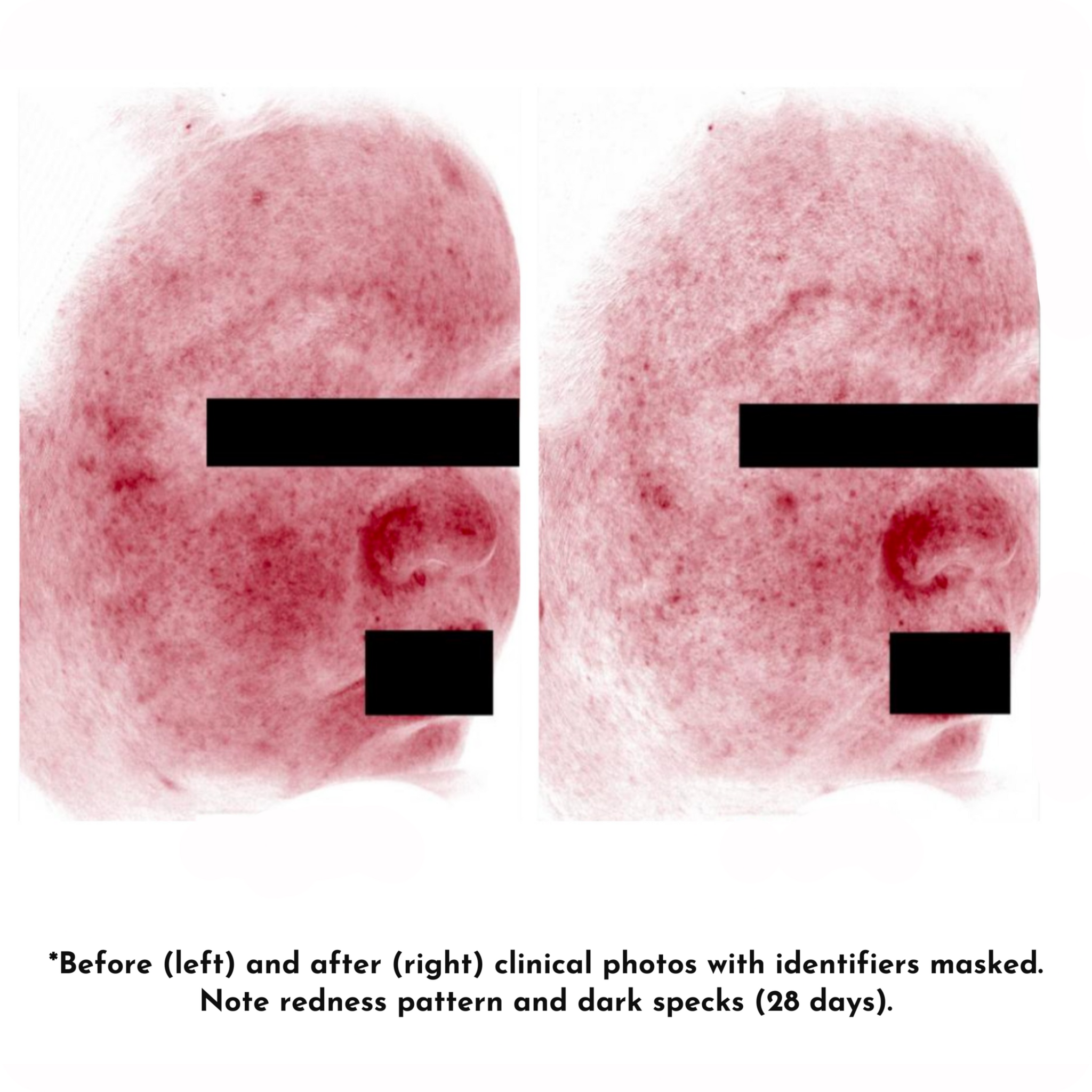 Before and after skin redness and dark spots reduction after 28 days of treatment