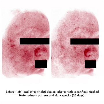 Before and after skin redness and dark spots reduction after 28 days of treatment